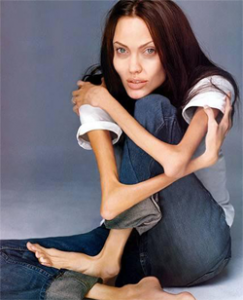 anorexia_nervosa_1
